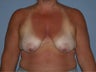 Breast Lift