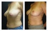 Breast Lift