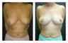 Breast Lift