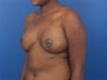 Breast Reconstruction following mastectomy