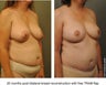 Breast Reconstruction