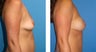 Breast Reconstruction: One-Stage Breast Reconstruction