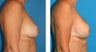 Breast Reconstruction: One-Stage Breast Reconstruction