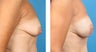 Breast Reconstruction: One-Stage Breast Reconstruction