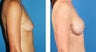 Breast Reconstruction: One-Stage Breast Reconstruction