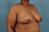 Breast Cancer Reconstruction After Mastectomy