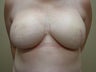 Nipple / Areola Reconstruction