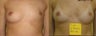 Breast Reconstruction