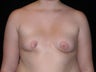Breast reconstruction