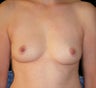 Breast reconstruction with silicone implants