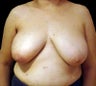 Breast Reconstruction - Left reduction, right silicone