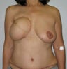Nipple Reconstruction