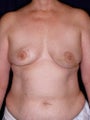 DIEP Flap Breast Reconstruction
