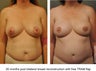 Breast Reconstruction