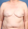 Breast Reconstruction
