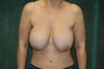 Women's Breast Augmentation: Redo 