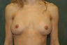 Women's Breast Augmentation: Redo 