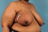 Breast Cancer Reconstruction After Mastectomy
