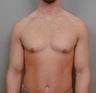 Breast Reduction