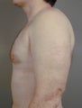 Breast Reduction