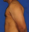 Breast Reduction