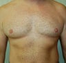 Male Breast Reduction