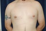 Gynecomastia