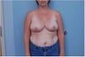 breast reduction