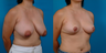 Breast reduction