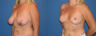 Breast reduction/breast lift