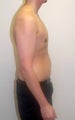 Gynecomastia