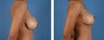 Breast Reduction