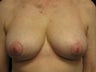 Breast reduction