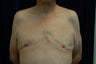 Gynecomastia with Liposuction