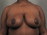 Breast Reduction