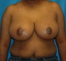 Breast Reduction