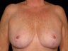 Breast Reduction