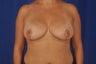 Breast Reduction