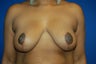 Breast Reduction