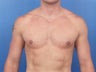 Male Breast Reduction