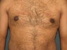 Male Breast Reduction (Gynecomastia)
