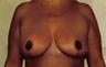 Breast Reduction