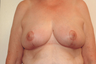 Breast Reduction