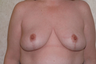 Breast Reduction