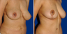 Breast Reduction