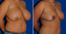 Breast Reduction