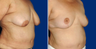 Breast Reduction