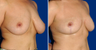 Breast Reduction