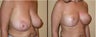 Breast Reduction
