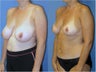 Breast Reduction